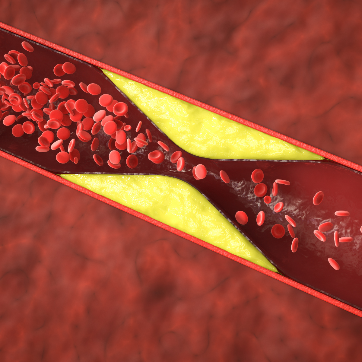 High Cholesterol / Dyslipidemia